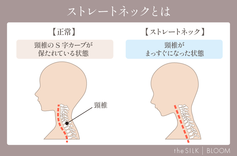 ストレートネックとは