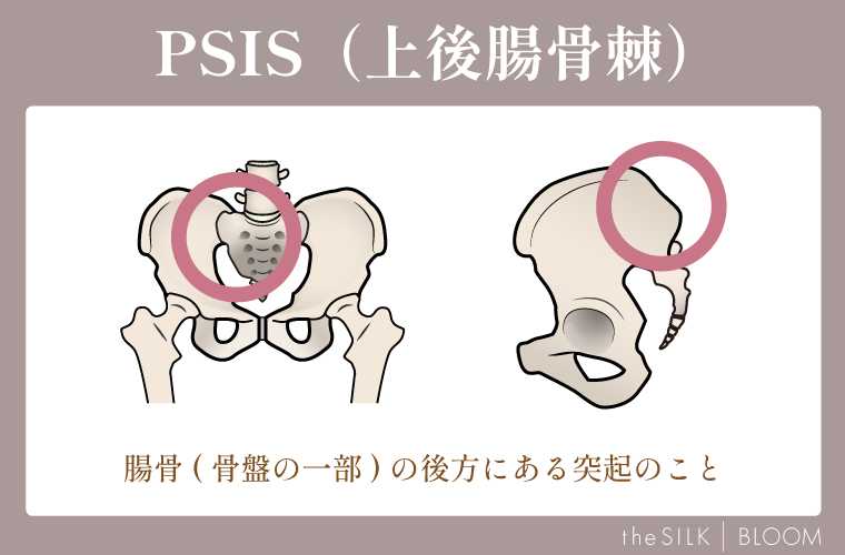 PSIS（上後腸骨棘）の画像